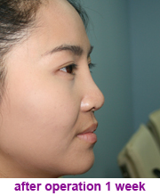 plastic_surgery_augmentation_rhinoplasty